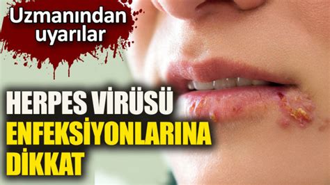 herpes virüsü tedavisi